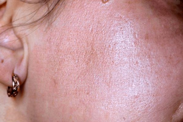 Κοκκίνισμα του δέρματος μετά την αναζωογόνηση με λέιζερ