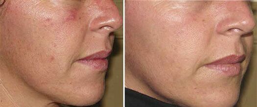Πρόσωπο πριν και μετά την αναζωογόνηση του δέρματος
